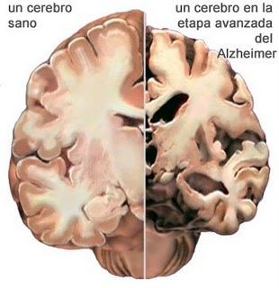 alzheimer